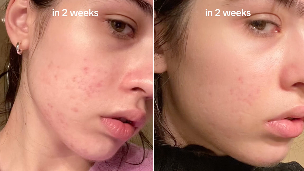 Anua niacinamide serum أقوى معالج للمسام و اثار الحبوب